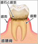 歯肉炎（P1）